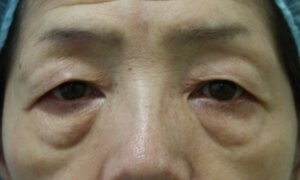 目の下のたるみ取り手術術前