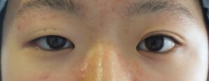 切らない眼瞼下垂治療ビフォー