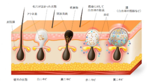 ニキビのイラスト