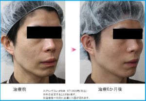 スプリングスレッド男性ビフォーアフター写真2