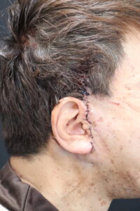 フェイスリフト手術直後の傷の状態