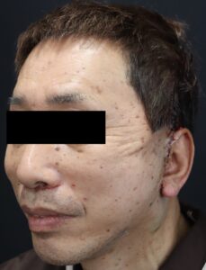 切開フェイスリフト男性手術直後
