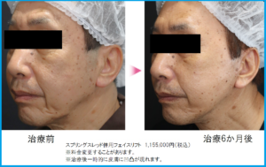 フェイスリフト男性手術前後写真2
