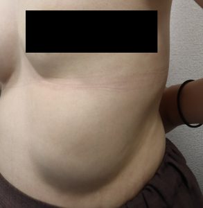 お腹移動したアクアフィリング