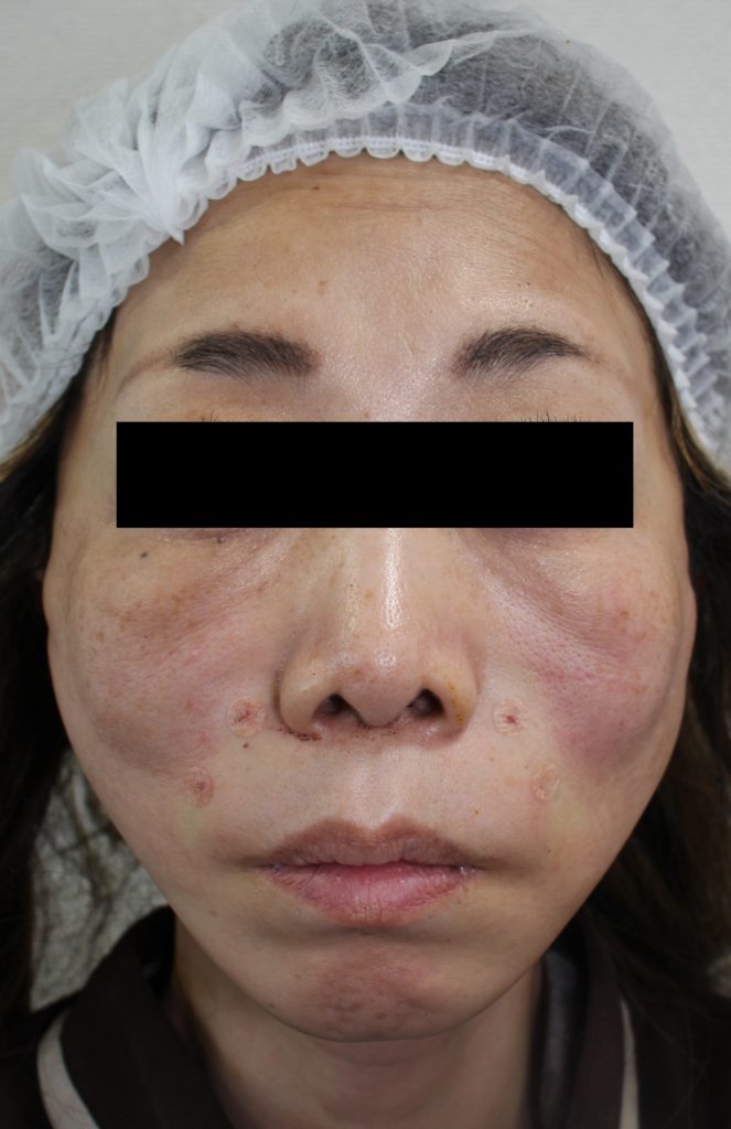 フェイスリフト手術の手術直後