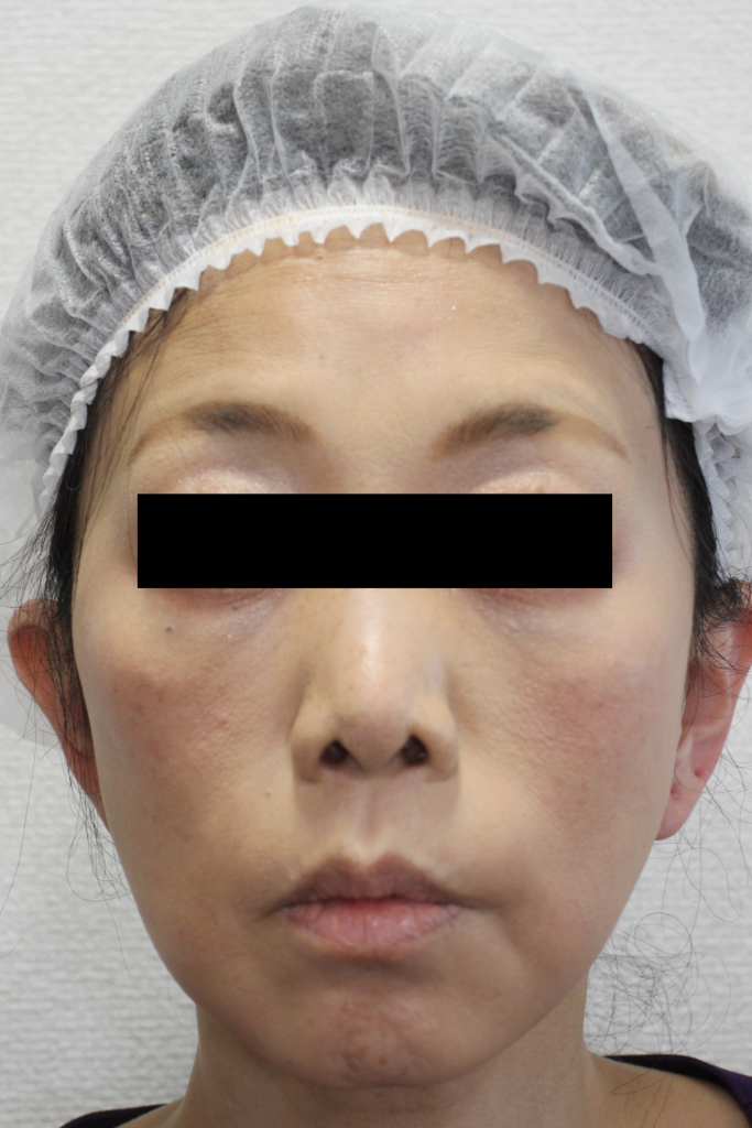 フェイスリフト手術の手術術後6か月