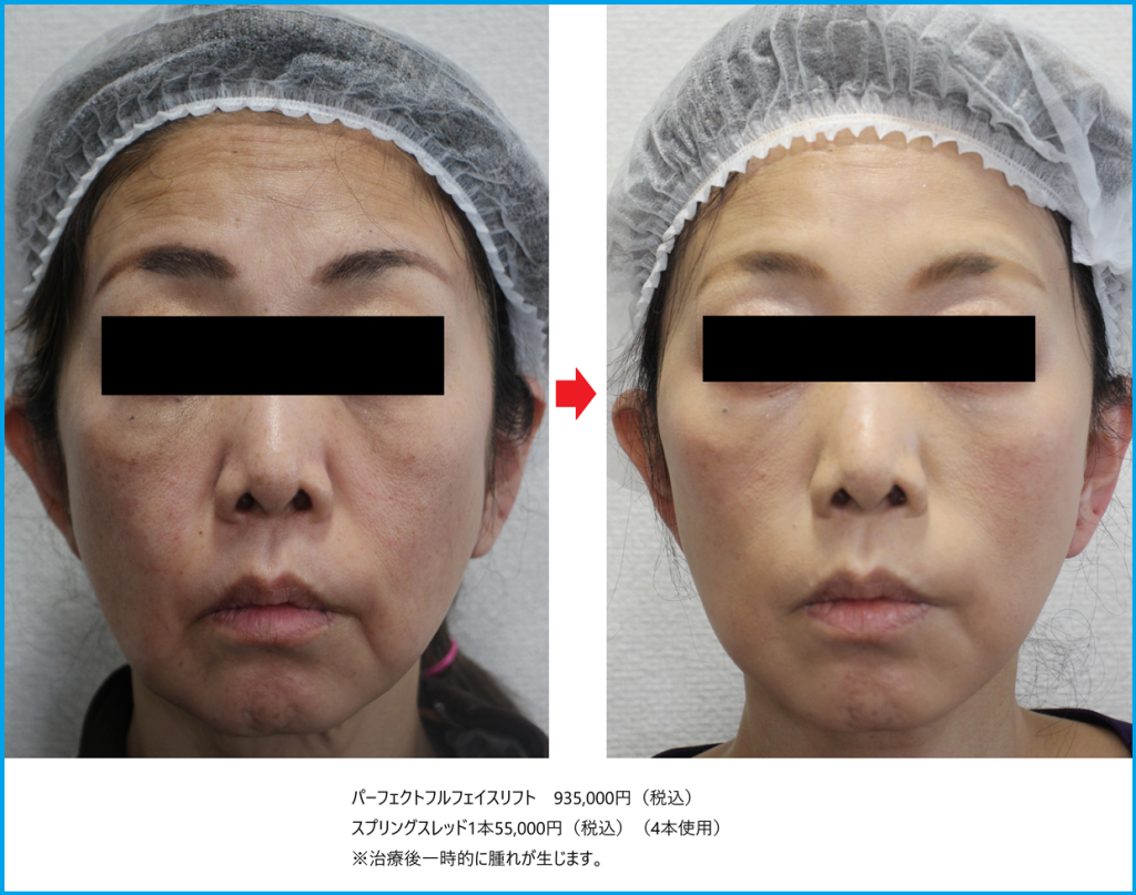フェイスリフト手術の手術前後症例写真