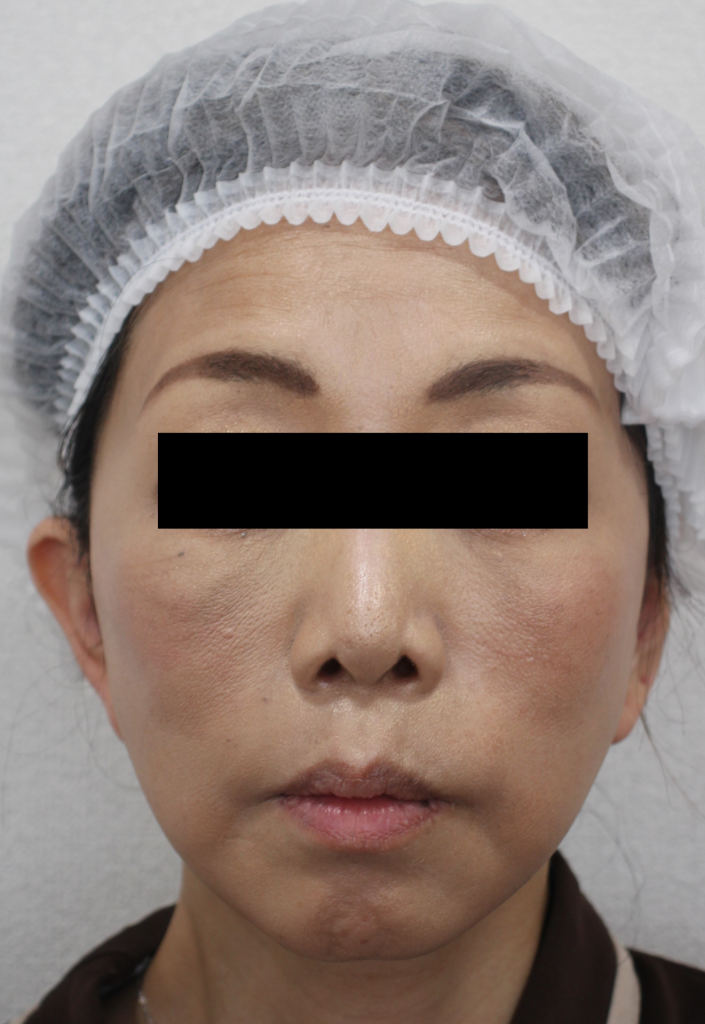 フェイスリフト手術の手術術後1週間