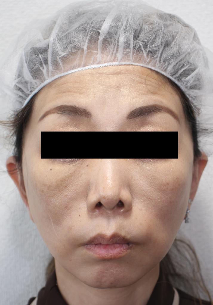 フェイスリフト手術の手術術後1か月