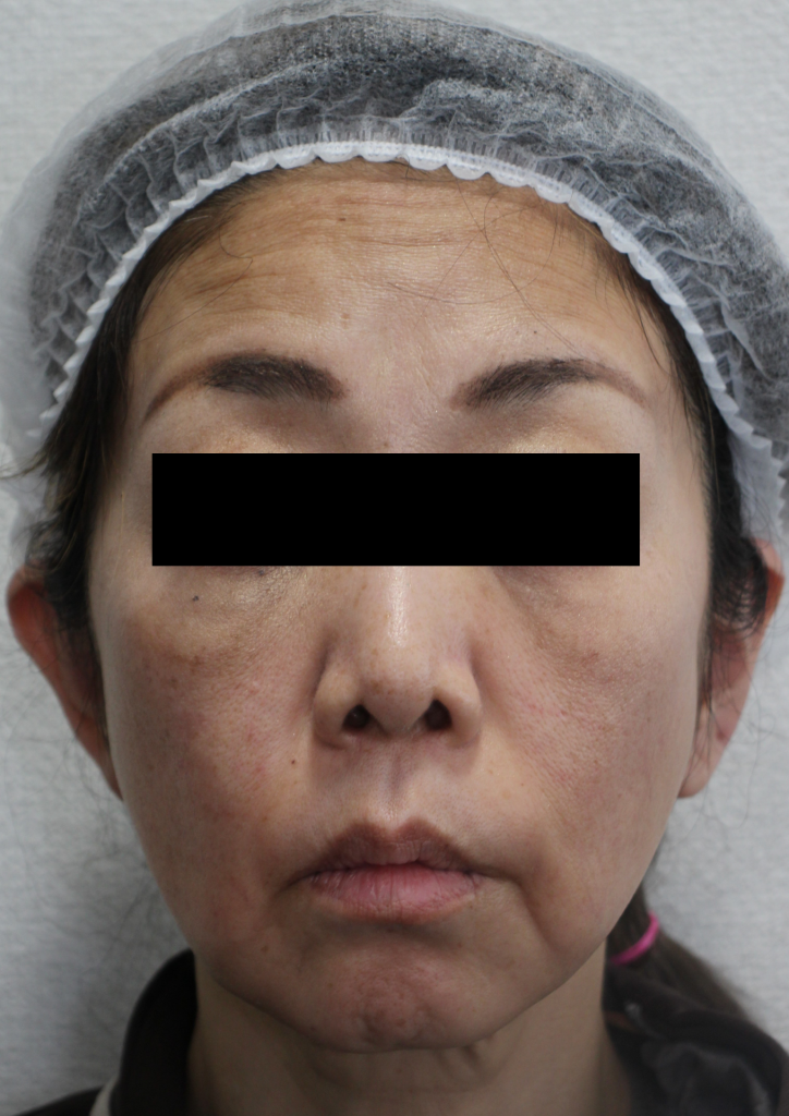 フェイスリフト手術の手術前1