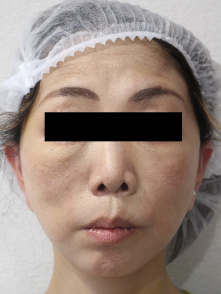 フェイスリフト手術の手術術後2週間