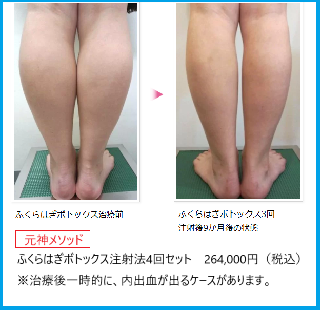 ふくらはぎボトックスビフォーアフター