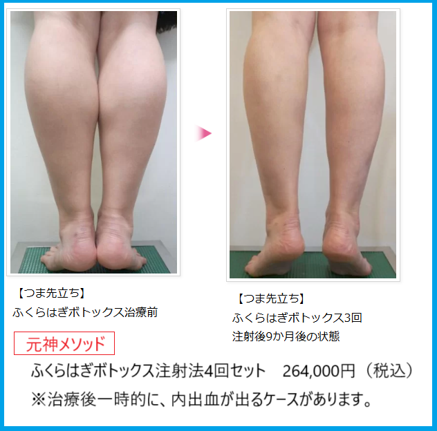 ふくらはぎボトックス注射前後
