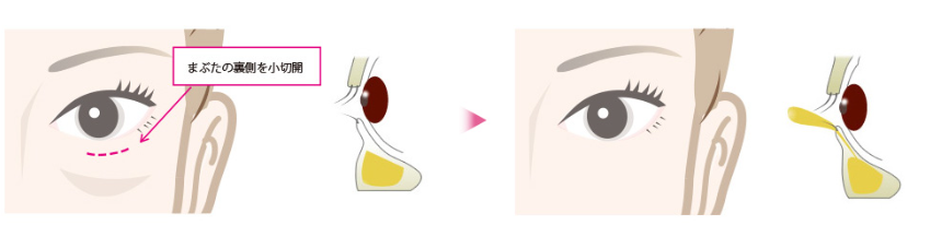 経結膜下眼瞼脂肪除去手術
