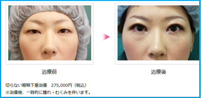 切らない眼瞼下垂症例写真
