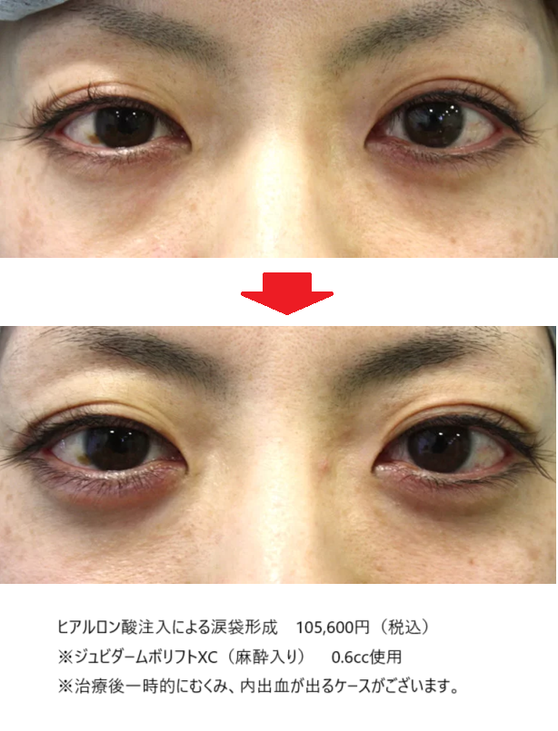 ↑筆者が行ったヒアルロン酸による涙袋形成症例写真