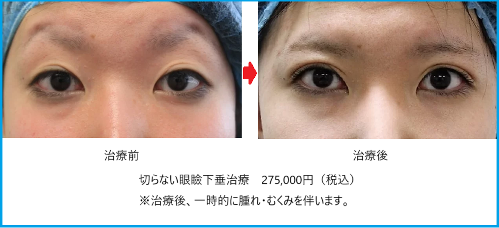 切らない眼瞼下垂症例写真