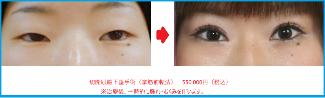切開眼瞼下垂症例写真