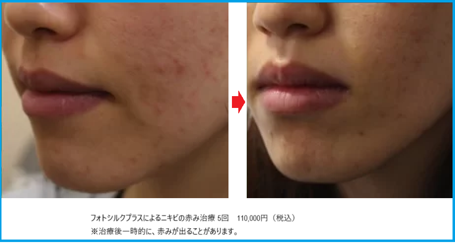 フォトシルクプラスのにきび治療ビフォーアフター