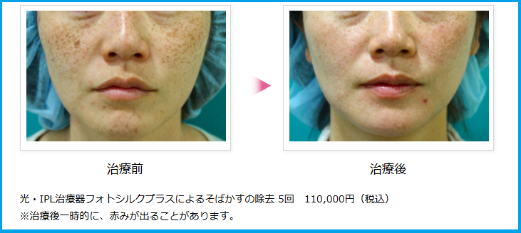フォトシルクプラスの治療前後