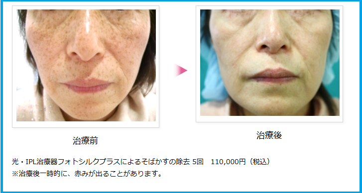 フォトシルクプラスのビフォーアフター