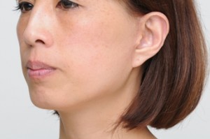 エラボトックスで小顔2