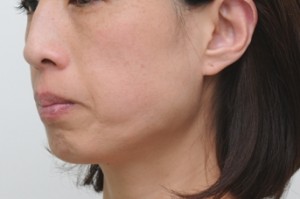 エラボトックスで小顔