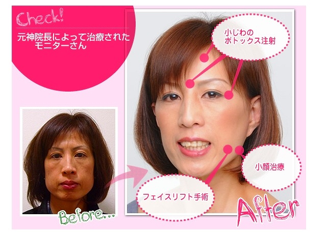 フェイスリフト手術説明 フェイスリフト手術説明