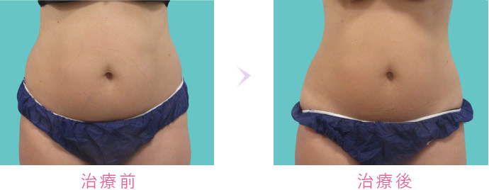 クールテック症例写真