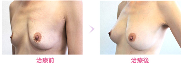 豊胸治療症例写真