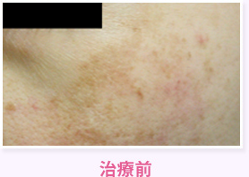治療前