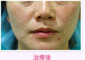 治療後