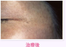 治療後