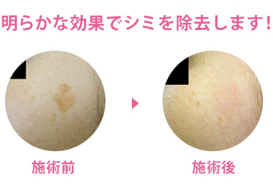 明らかな効果でシミを除去します！