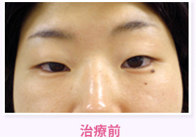治療前