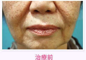 治療前