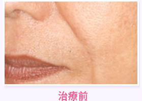 治療前