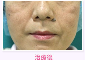 治療後