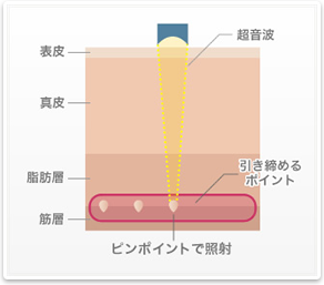 HIFUの熱を皮膚の深部へ集中させる仕組み