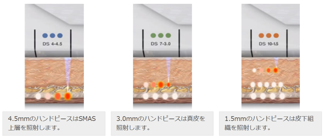 ウルセラがSMAS層まで熱エネルギーを届ける様子