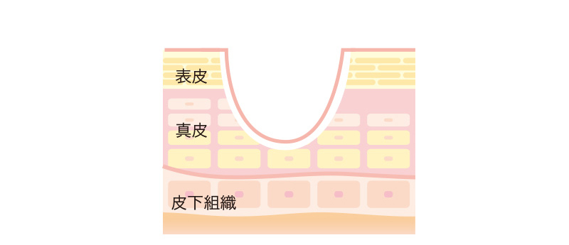 ニキビ跡　ローリングタイプ