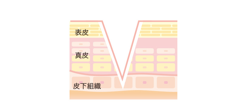 ニキビ跡　アイスピックタイプ