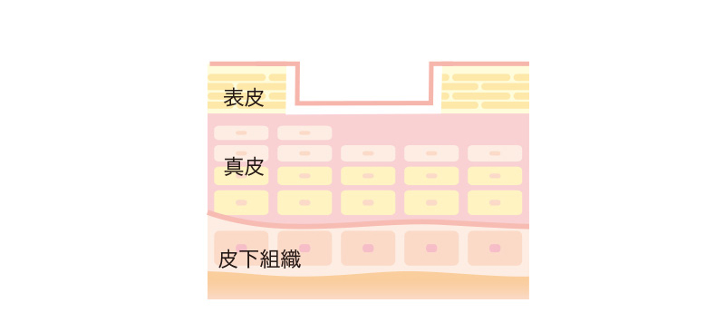 ニキビ跡　ボックスタイプ
