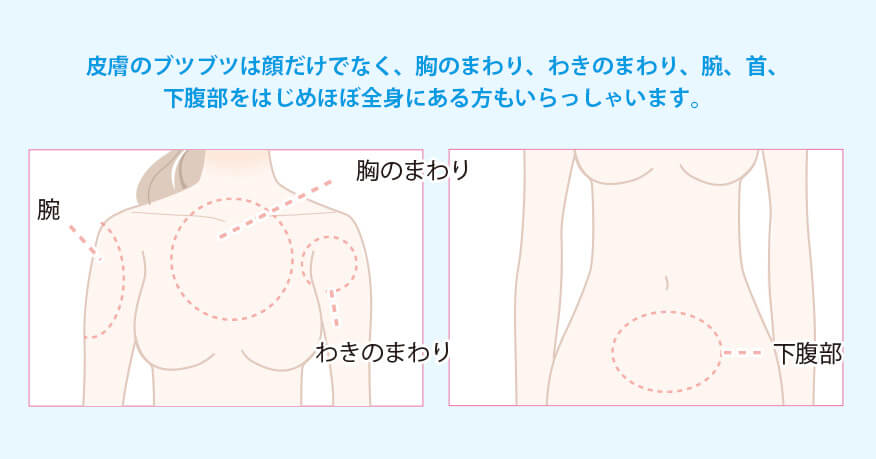 ほぼ全身に発症される方もいらっしゃいます
