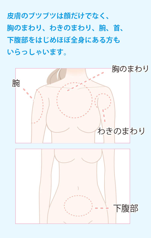 ほぼ全身に発症される方もいらっしゃいます