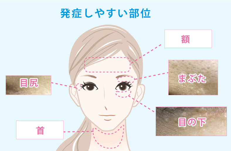 発症しやすい部位