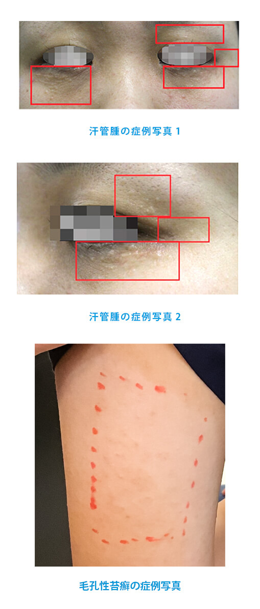 毛孔性苔癬（もうこうせいたいせん）の症例写真