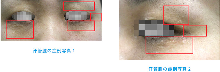 汗管腫（かんかんしゅ）の症例写真1