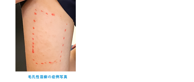 汗管腫（かんかんしゅ）の症例写真2