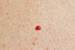 胸元にある老人性血管腫